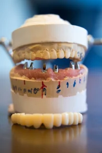 6 implants 684x1024