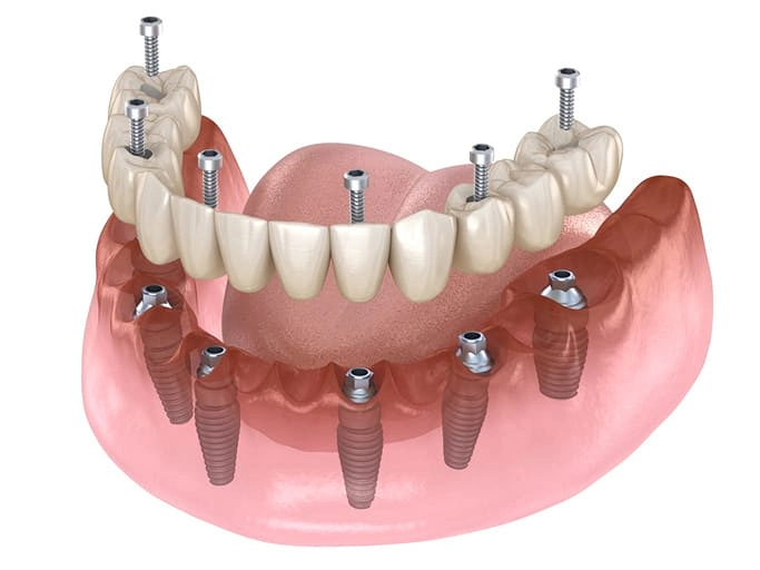 all on 6 dental implants