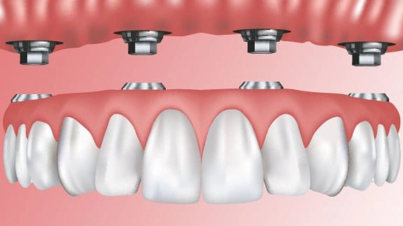 body img implant dentures 02