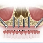 zigomatic implants 150x150